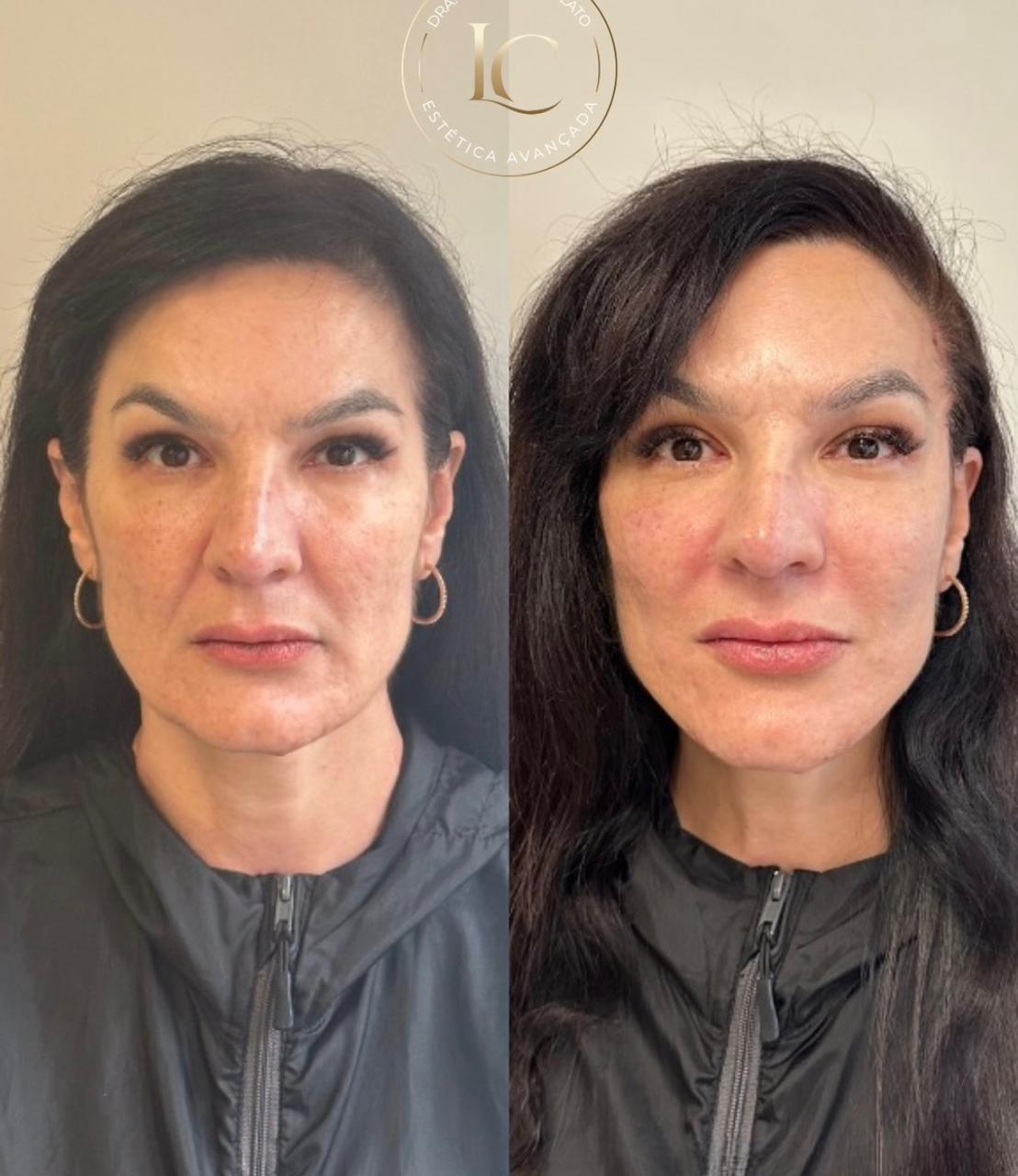 Antes e depois Método Time Reverse 1