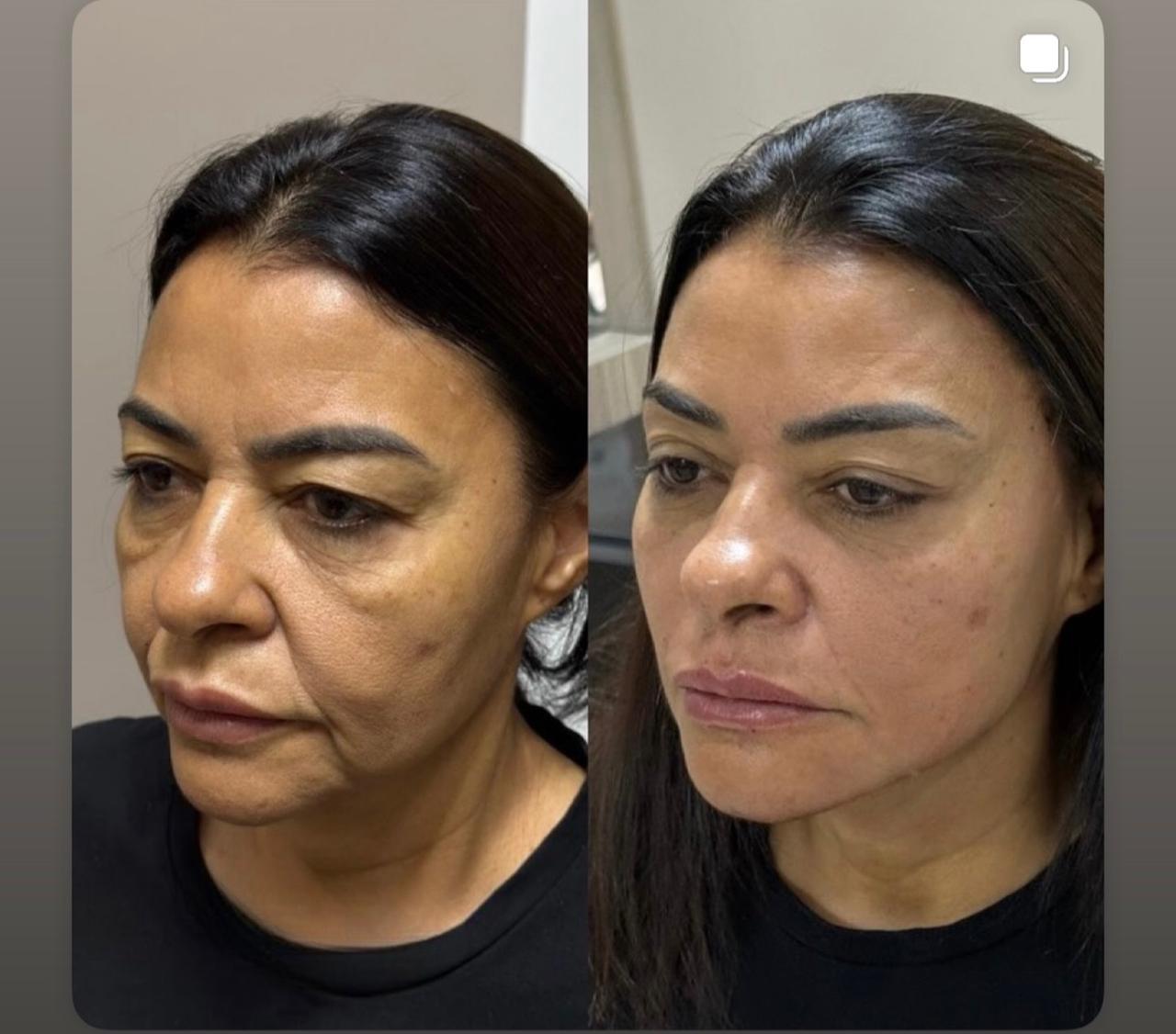 Antes e depois Método Time Reverse 3